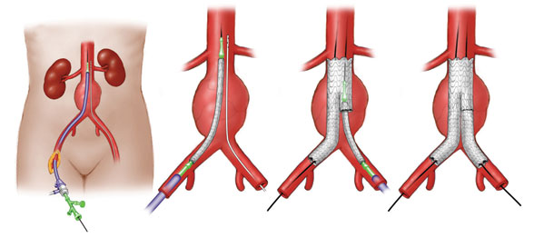Aneurysm-repair Aneurysm repair