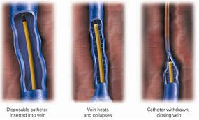 Rf ablation vein