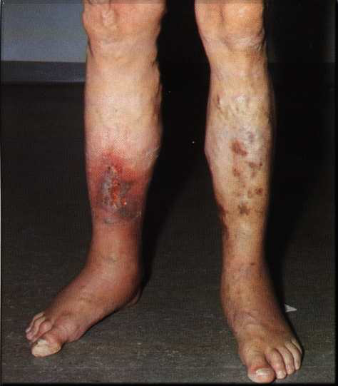 Venous ulceration